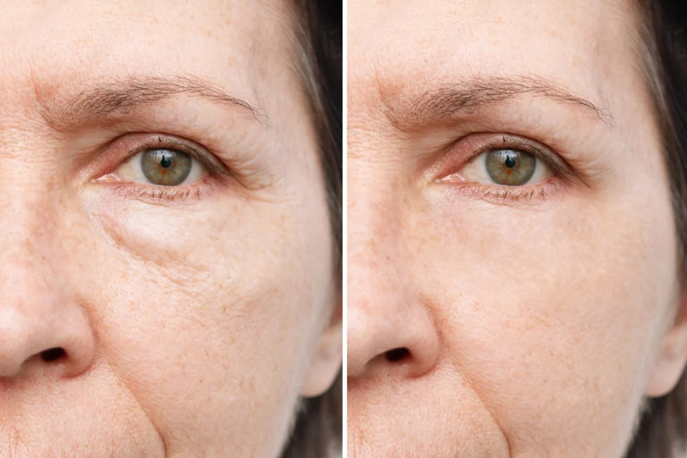 Before and After of a woman's undereyes