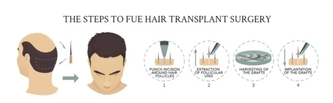 Hair restoration illustration