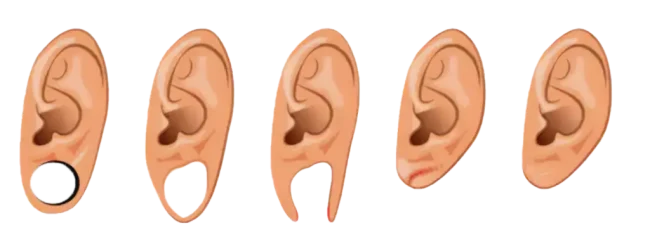 earlobe repair illustration
