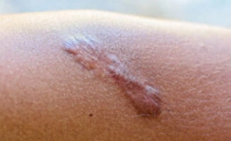keloid scar