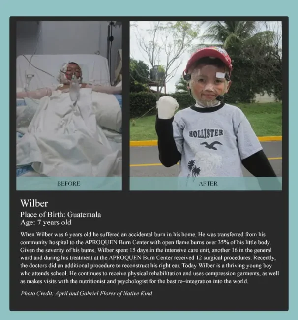 Before and after image of a child after surgical treatment