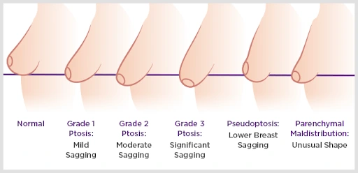 Understanding Breast Ptosis Classification