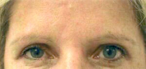 Case # 15 after photo