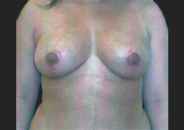 Case # 23 after photo