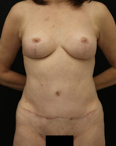 Case # 1 after photo