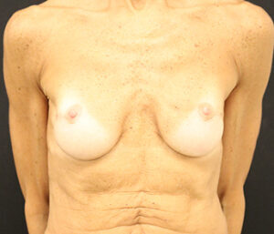 Case # 9 after photo