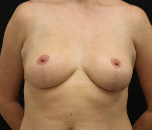 Case # 2 after photo