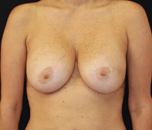 Case # 1 before photo