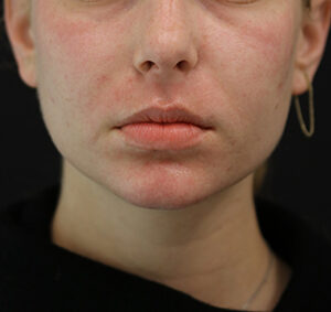 Case # 1 after photo