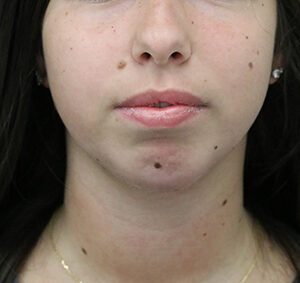 Case # 2 after photo