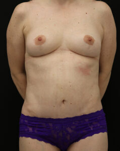 Case # 2 after photo