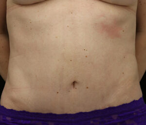 Case # 3 after photo