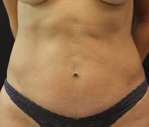 Case # 4 after photo