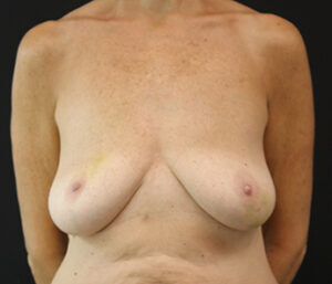 Case # 11 before photo