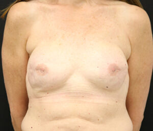 Case # 11 after photo