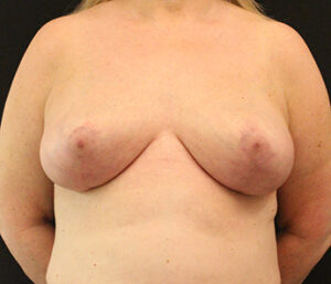 Case # 3 after photo