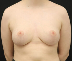 Case # 4 after photo