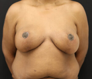 Case # 5 after photo