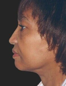 Case # 2 after photo