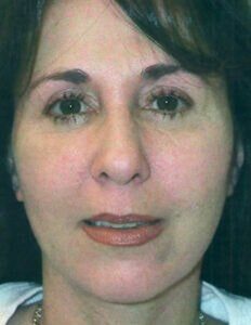 Case # 4 after photo