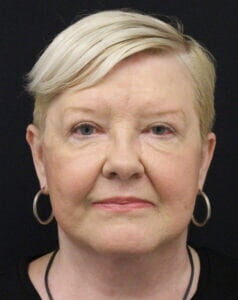 Case # 6 after photo