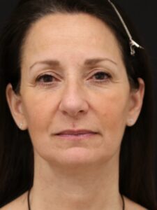 Case # 7 after photo