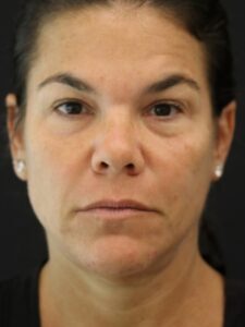 Case # 9 before photo