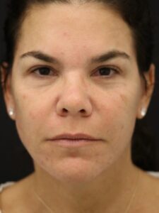 Case # 9 after photo