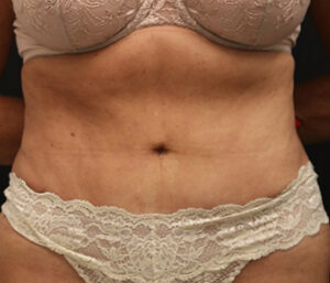 Case # 5 after photo