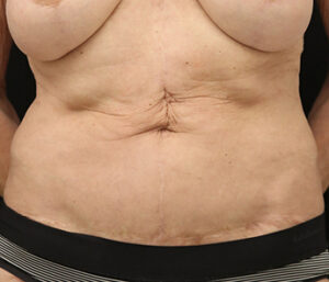 Case # 6 after photo