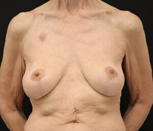 Case # 6 after photo