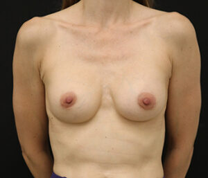 Case # 5 after photo