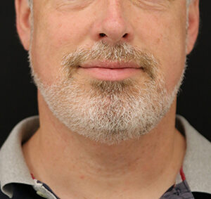 Case # 3 after photo