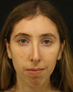 Case # 11 after photo