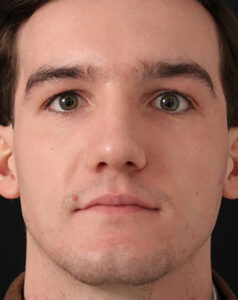 Case # 8 after photo