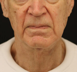 Case # 4 after photo