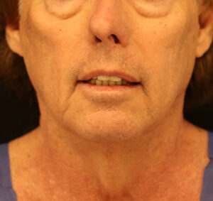 Case # 5 before photo