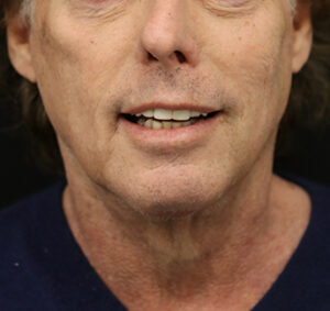 Case # 5 after photo