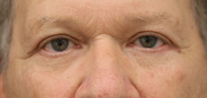 Case # 4 after photo