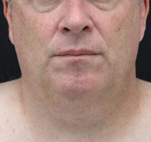 Case # 7 before photo