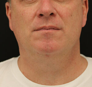 Case # 7 after photo