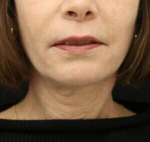 Case # 1 after photo