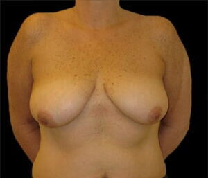 Case # 1 before photo