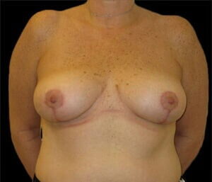 Case # 1 after photo