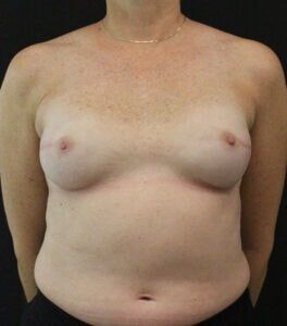 Case # 12 after photo