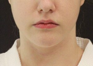 Case # 14 before photo