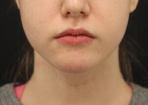 Case # 14 after photo