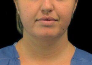 Case # 12 before photo