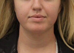 Case # 12 after photo