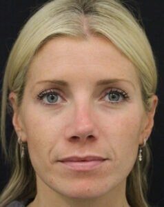 Case # 13 before photo